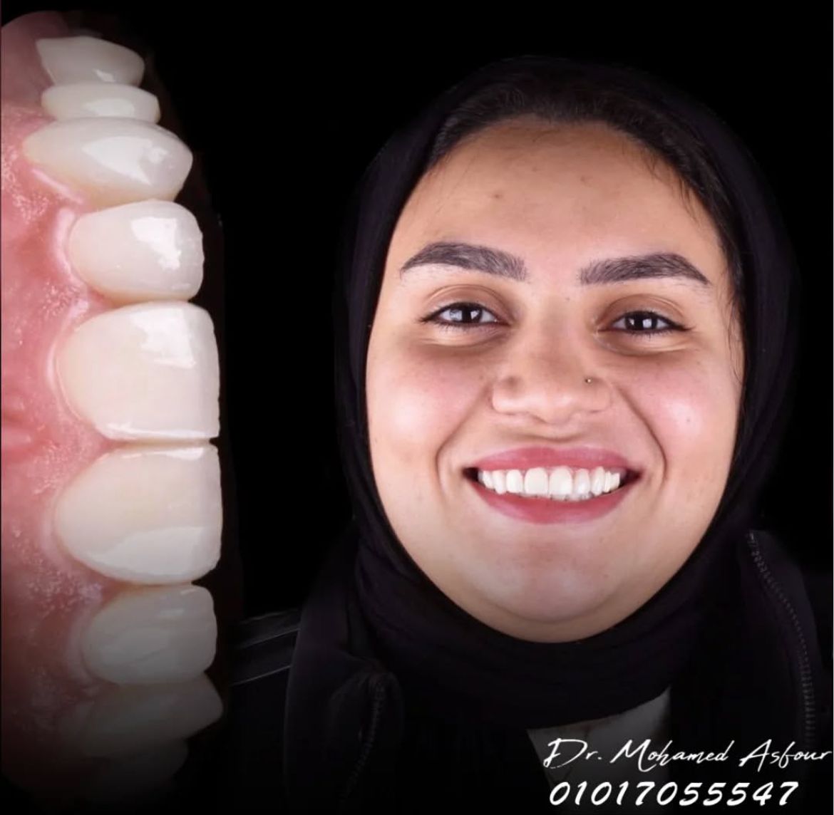 زراعة الأسنان